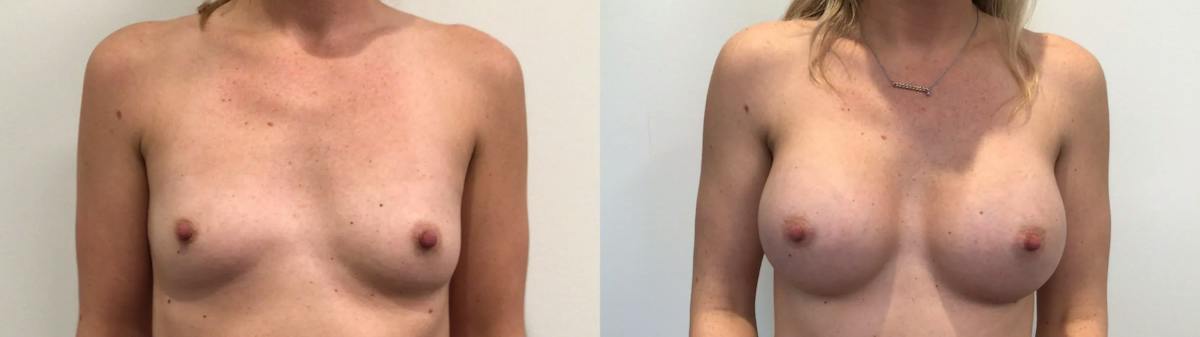 Breast Augmentation Before & After Gallery - Patient 159456 - Image 1