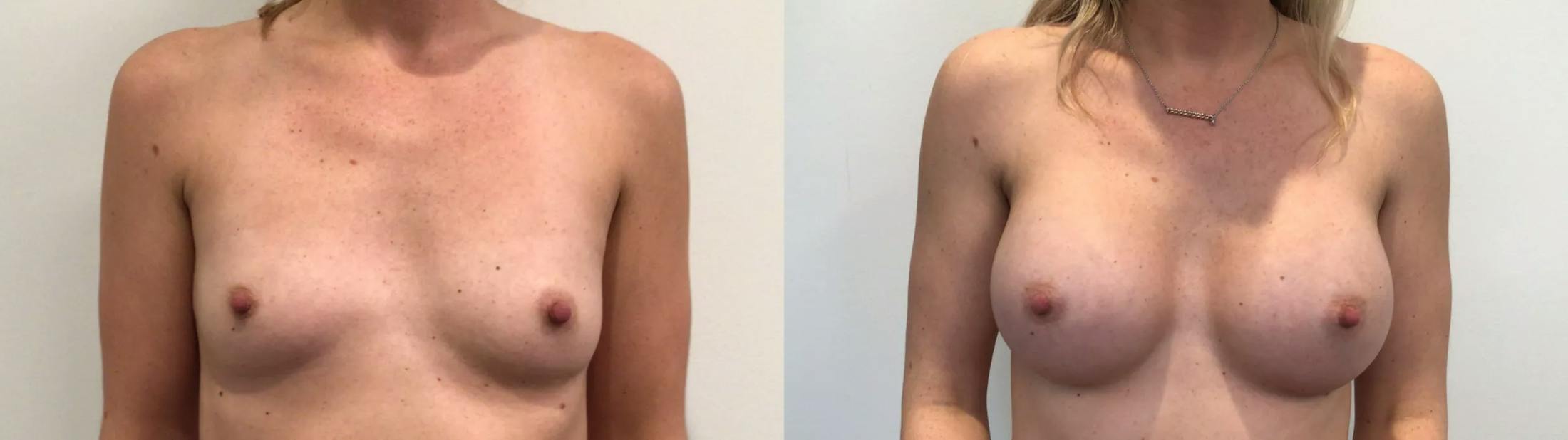 Breast Augmentation Before & After Gallery - Patient 159456 - Image 1