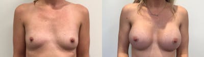 Breast Augmentation Before & After Gallery - Patient 159456 - Image 1