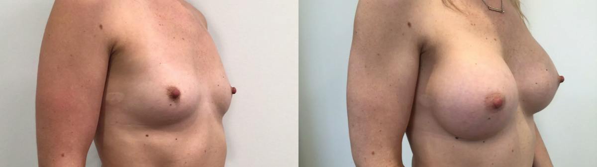 Breast Augmentation Before & After Gallery - Patient 159456 - Image 2