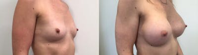 Breast Augmentation Before & After Gallery - Patient 159456 - Image 2