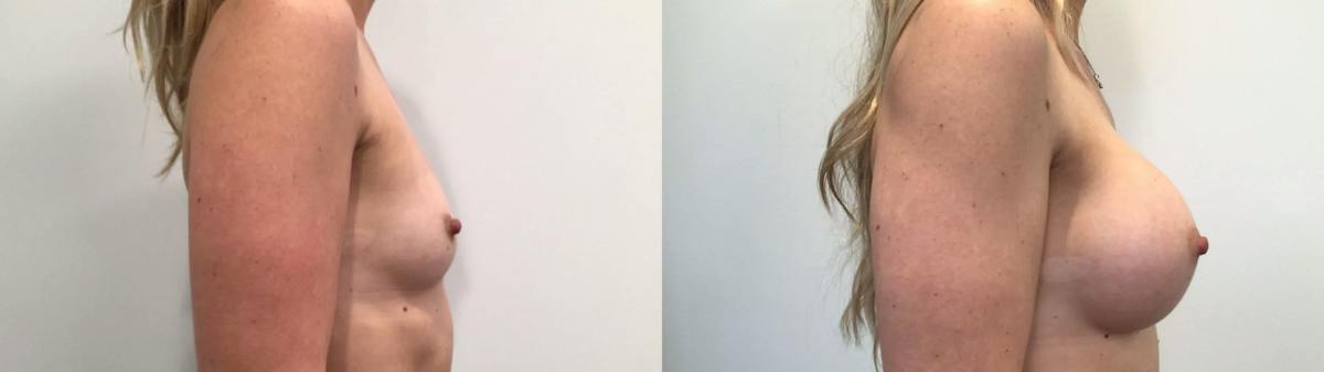 Breast Augmentation Before & After Gallery - Patient 159456 - Image 3
