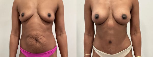Breast Augmentation Before & After Gallery - Patient 369343 - Image 1