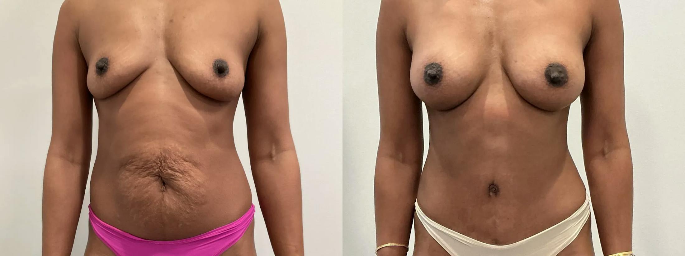Breast Augmentation Before & After Gallery - Patient 369343 - Image 1