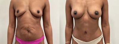 Breast Augmentation Before & After Gallery - Patient 369343 - Image 1