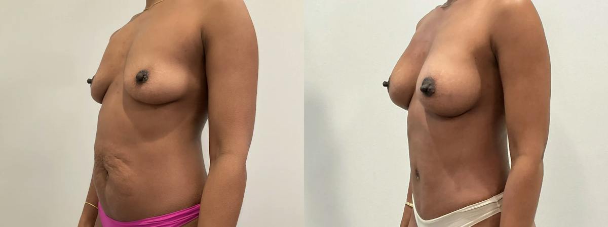 Breast Augmentation Before & After Gallery - Patient 369343 - Image 2