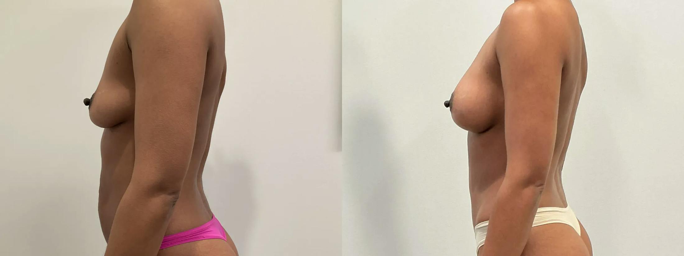 Breast Augmentation Before & After Gallery - Patient 369343 - Image 3