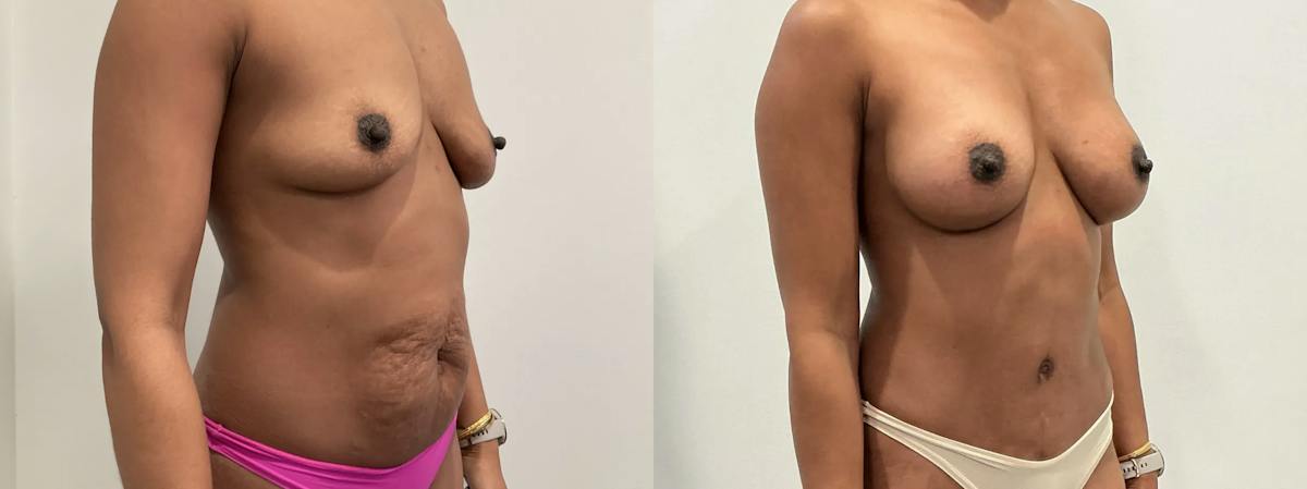 Breast Augmentation Before & After Gallery - Patient 369343 - Image 4