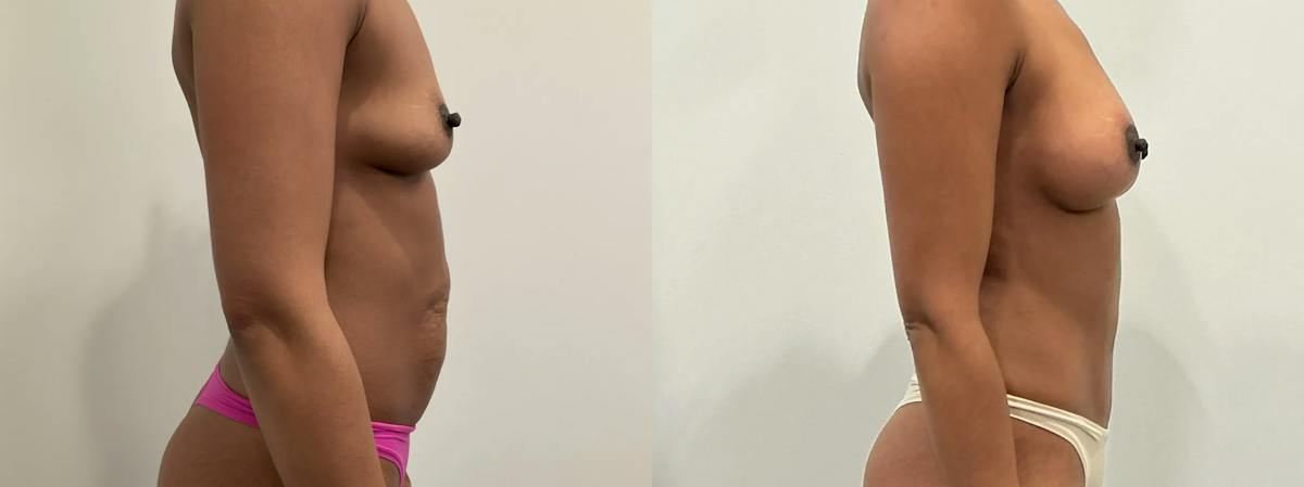 Breast Augmentation Before & After Gallery - Patient 369343 - Image 5