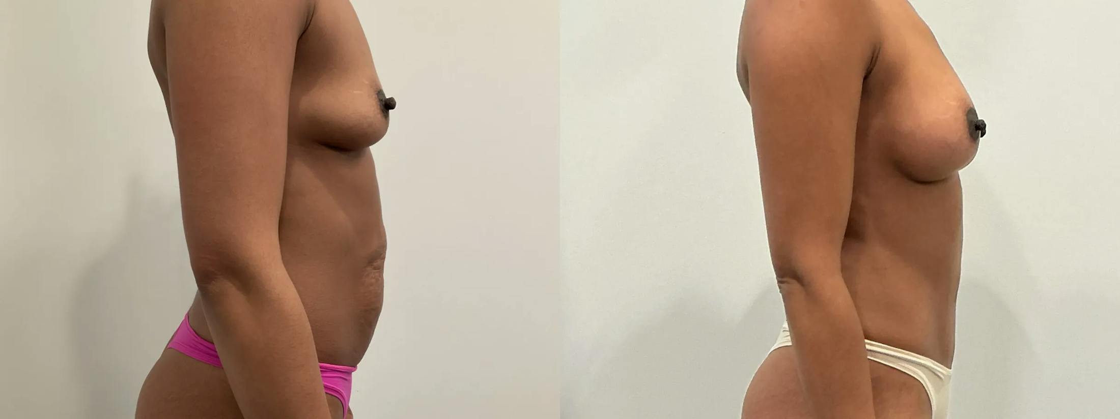Breast Augmentation Before & After Gallery - Patient 369343 - Image 5