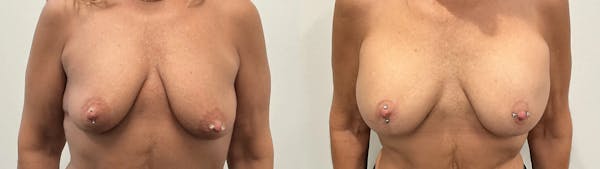 Breast Augmentation Before & After Gallery - Patient 955052 - Image 1