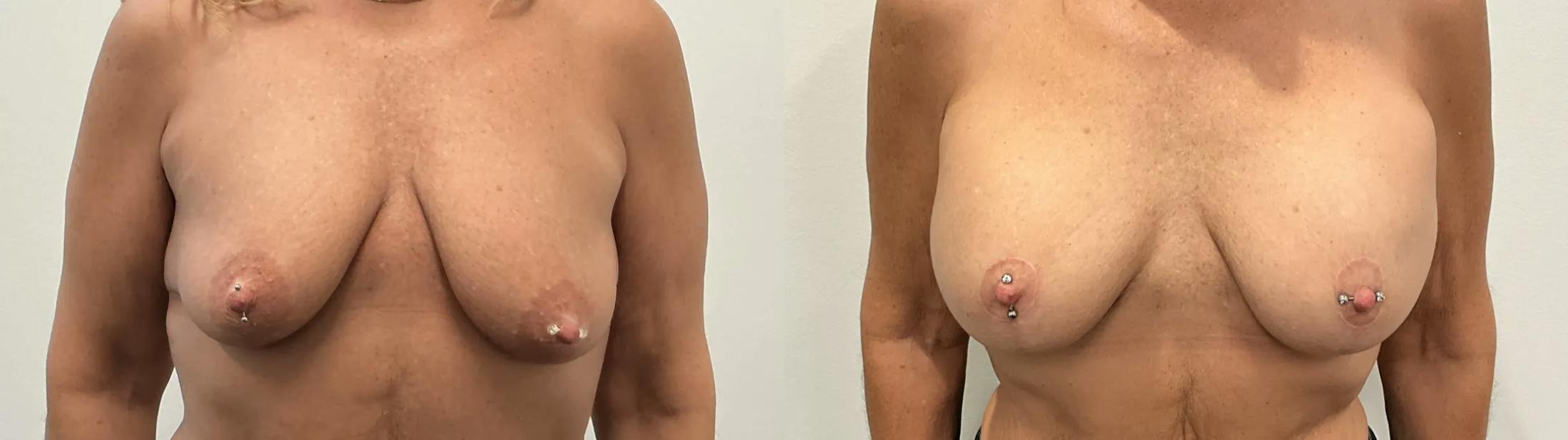 Breast Augmentation Before & After Gallery - Patient 955052 - Image 1
