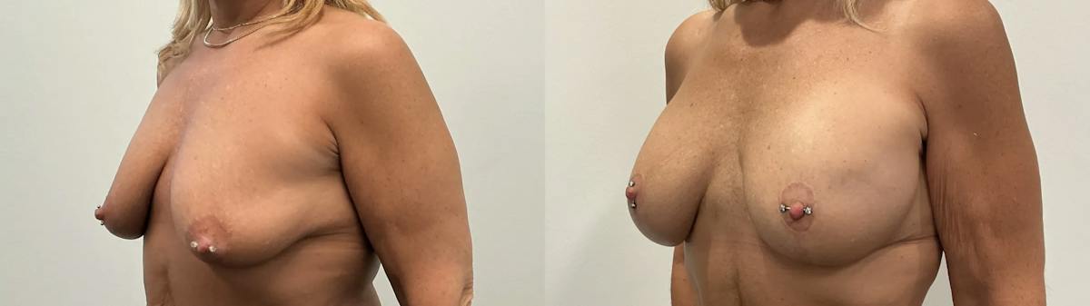 Breast Augmentation Before & After Gallery - Patient 955052 - Image 3