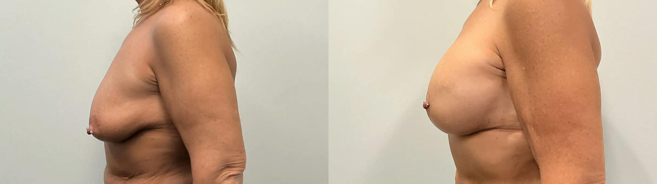 Breast Augmentation Before & After Gallery - Patient 955052 - Image 4