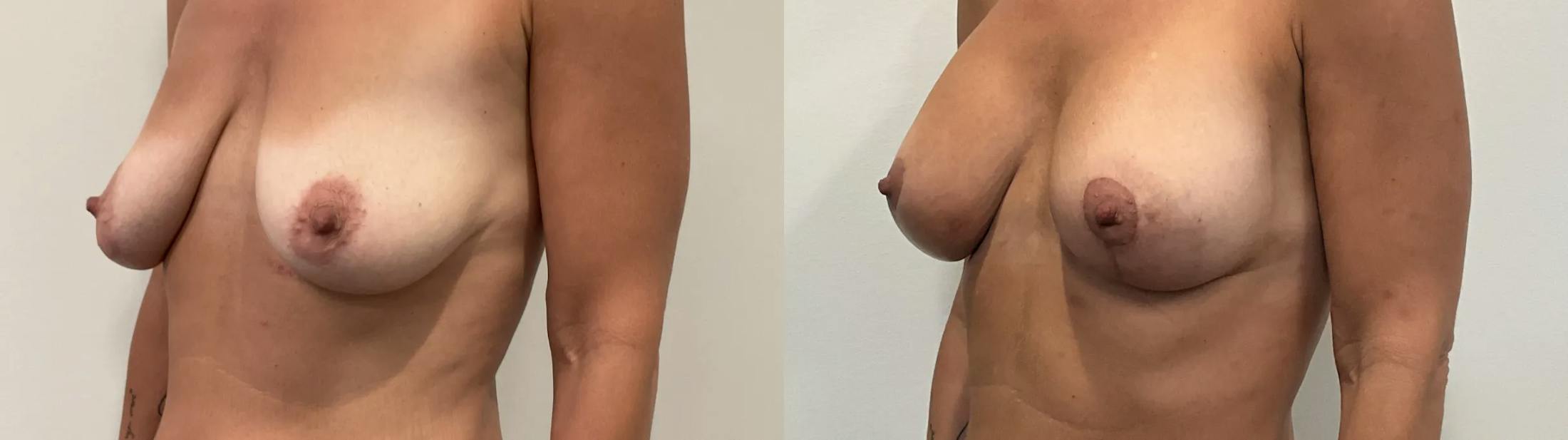 Breast Lift Before & After Gallery - Patient 728636 - Image 2