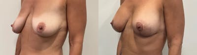 Breast Augmentation Before & After Gallery - Patient 309965 - Image 2