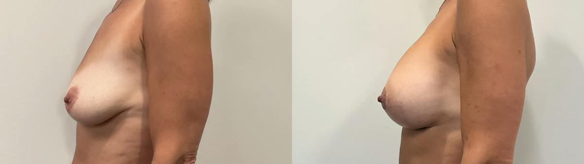 Breast Lift Before & After Gallery - Patient 728636 - Image 3