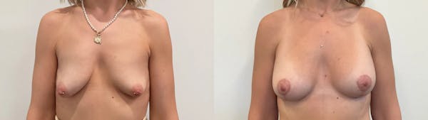 Breast Augmentation Before & After Gallery - Patient 166757 - Image 1
