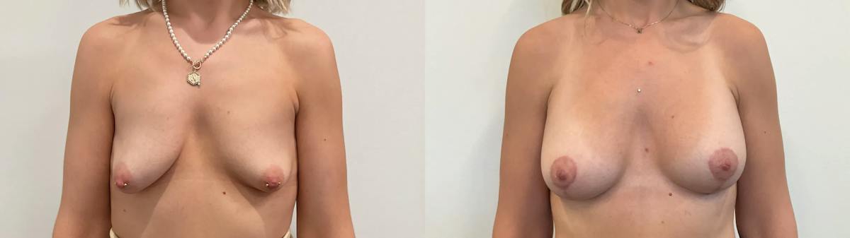 Breast Augmentation Before & After Gallery - Patient 166757 - Image 1