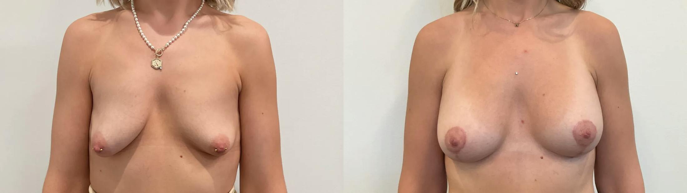 Breast Augmentation Before & After Gallery - Patient 166757 - Image 1