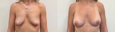 Breast Augmentation Before & After Gallery - Patient 166757 - Image 1