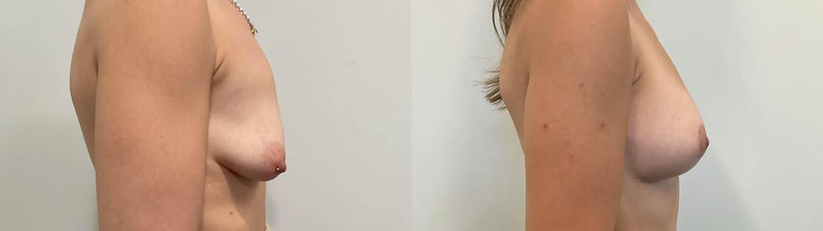 Breast Augmentation Before & After Gallery - Patient 166757 - Image 3