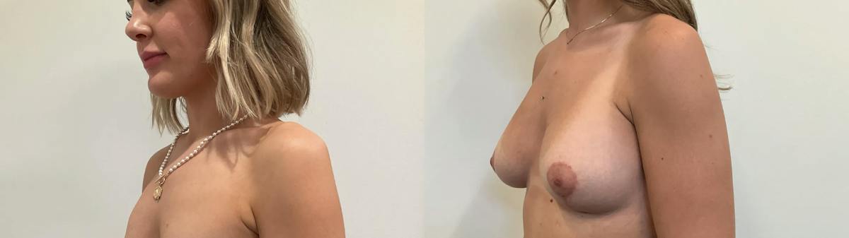 Breast Augmentation Before & After Gallery - Patient 166757 - Image 4