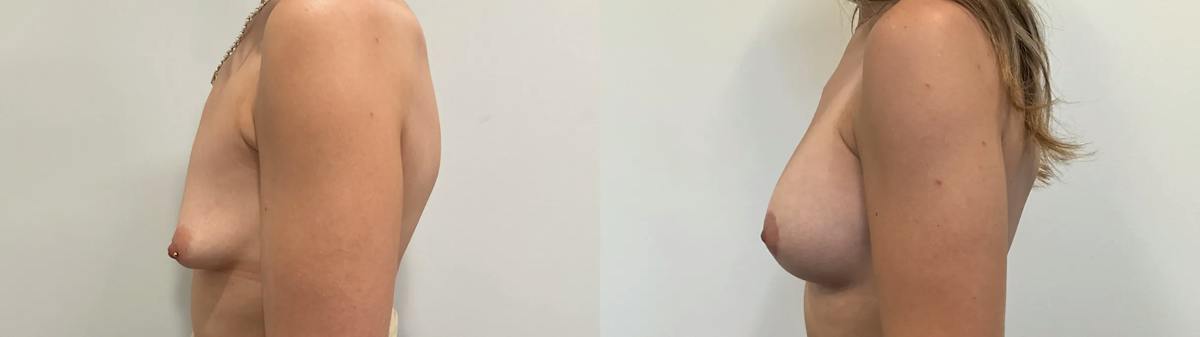 Breast Augmentation Before & After Gallery - Patient 166757 - Image 5