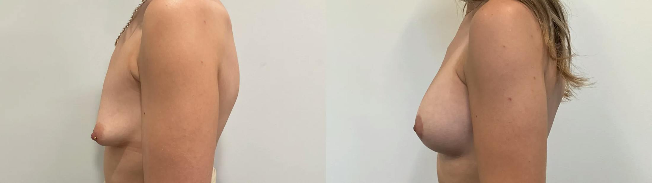 Breast Augmentation Before & After Gallery - Patient 166757 - Image 5