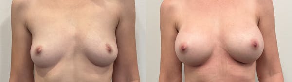 Breast Augmentation Before & After Gallery - Patient 295605 - Image 1