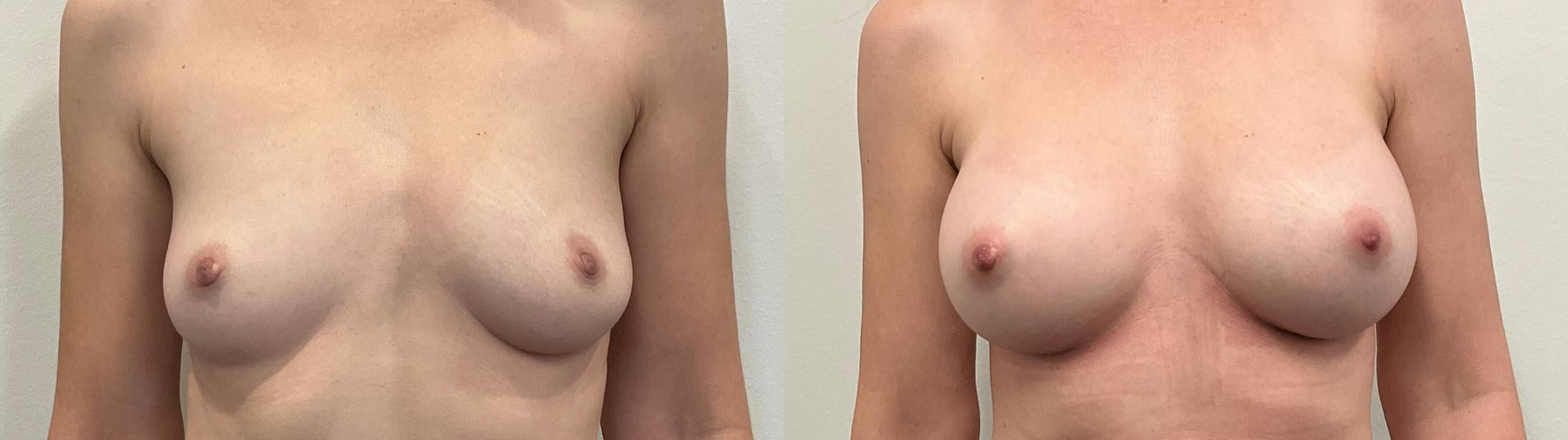 Breast Augmentation Before & After Gallery - Patient 295605 - Image 1