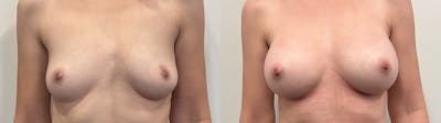 Breast Augmentation Before & After Gallery - Patient 295605 - Image 1