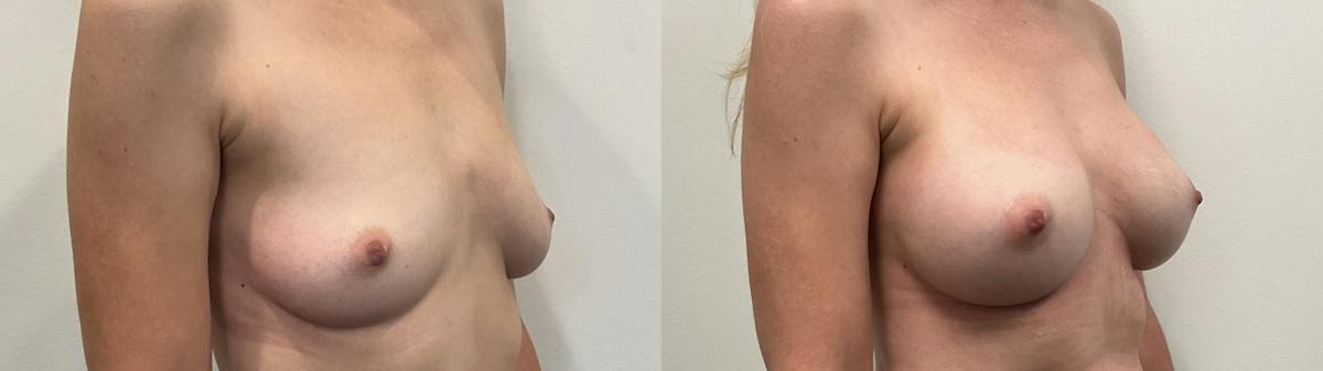 Breast Augmentation Before & After Gallery - Patient 295605 - Image 2