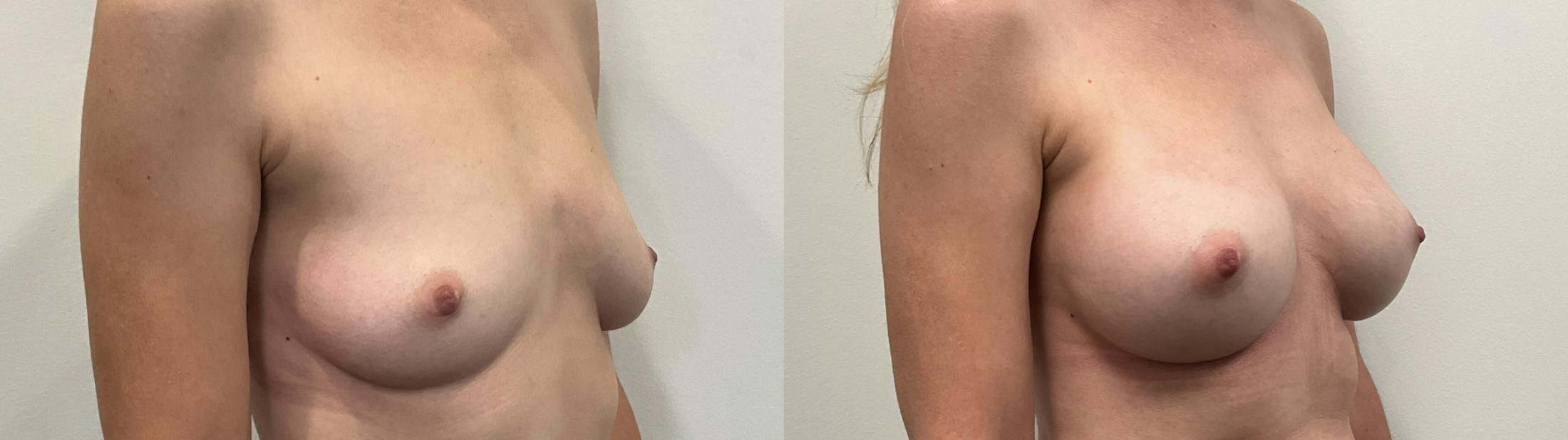 Breast Augmentation Before & After Gallery - Patient 295605 - Image 2