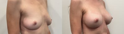 Breast Augmentation Before & After Gallery - Patient 295605 - Image 2