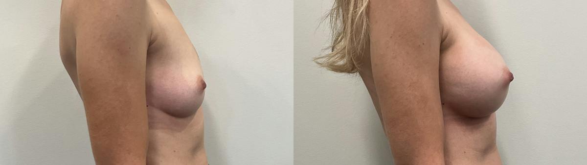 Breast Augmentation Before & After Gallery - Patient 295605 - Image 3