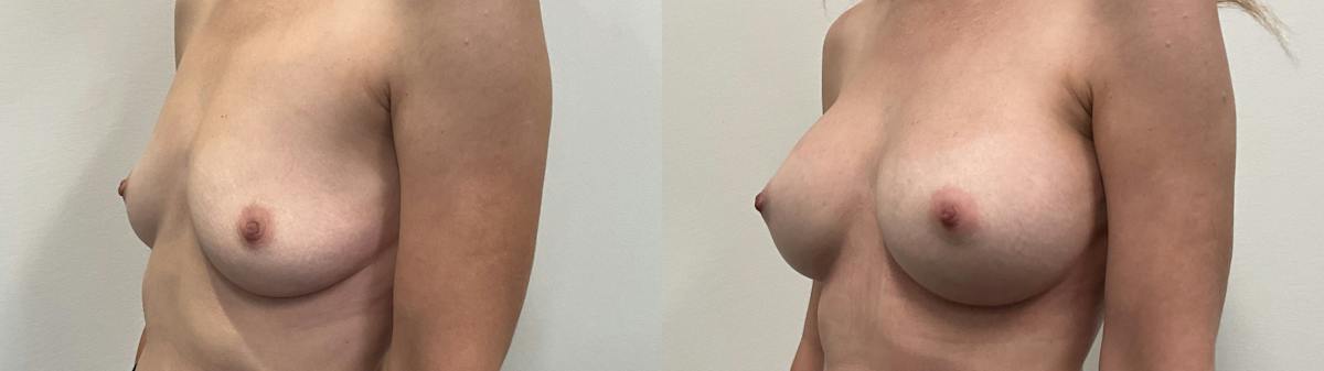 Breast Augmentation Before & After Gallery - Patient 295605 - Image 4