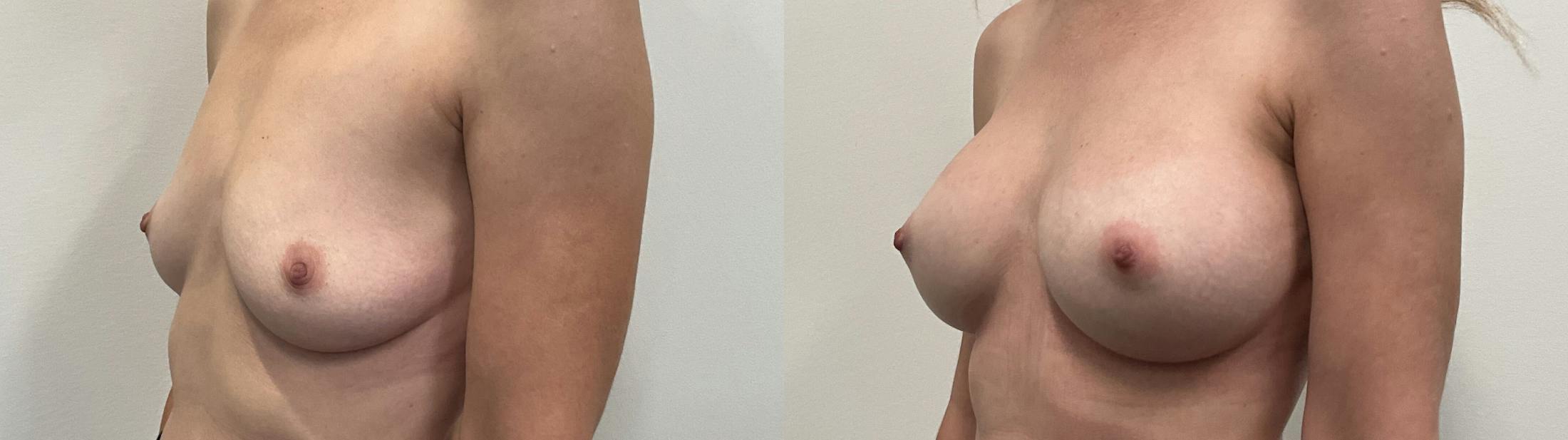 Breast Augmentation Before & After Gallery - Patient 295605 - Image 4