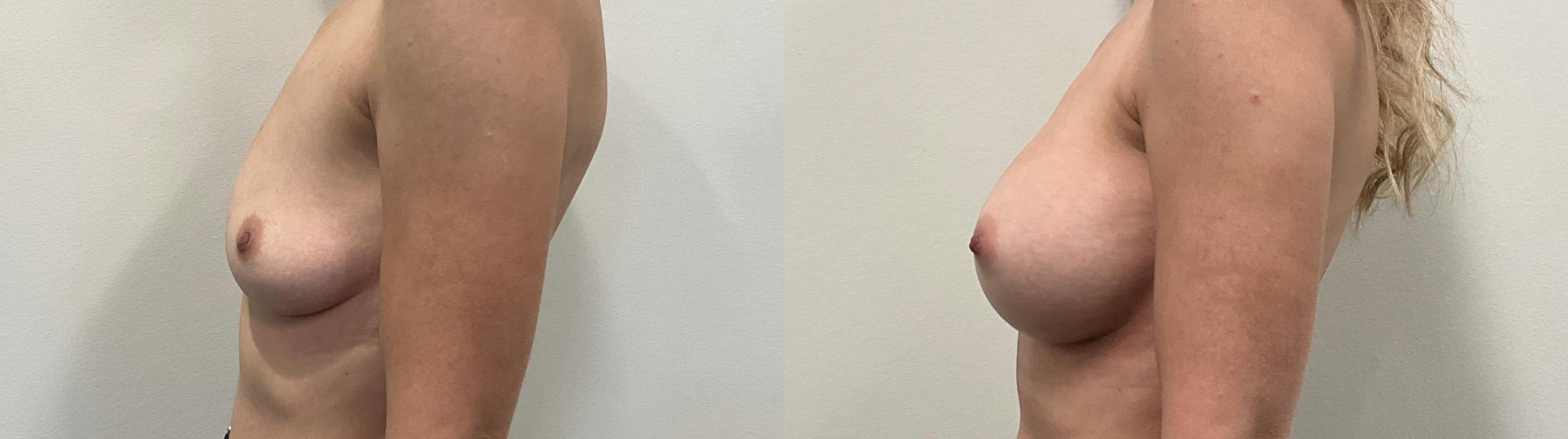 Breast Augmentation Before & After Gallery - Patient 295605 - Image 5