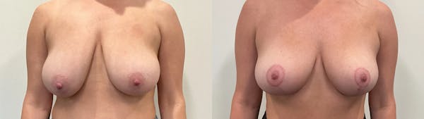 Breast Lift Before & After Gallery - Patient 293394 - Image 1