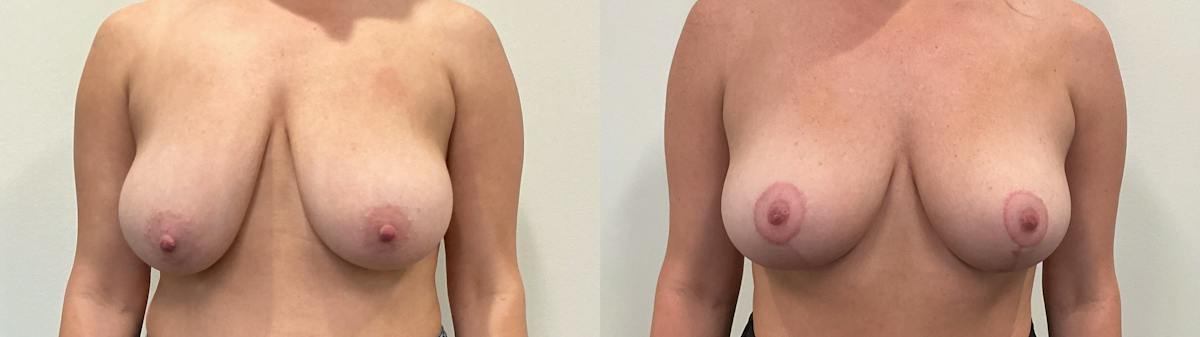 Breast Augmentation Before & After Gallery - Patient 869710 - Image 1