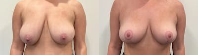 Breast Augmentation Before & After Gallery - Patient 869710 - Image 1