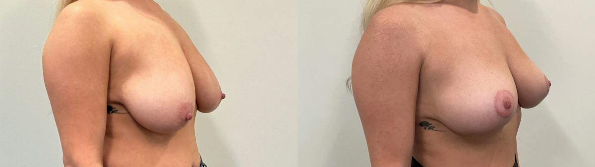 Breast Augmentation Before & After Gallery - Patient 869710 - Image 2