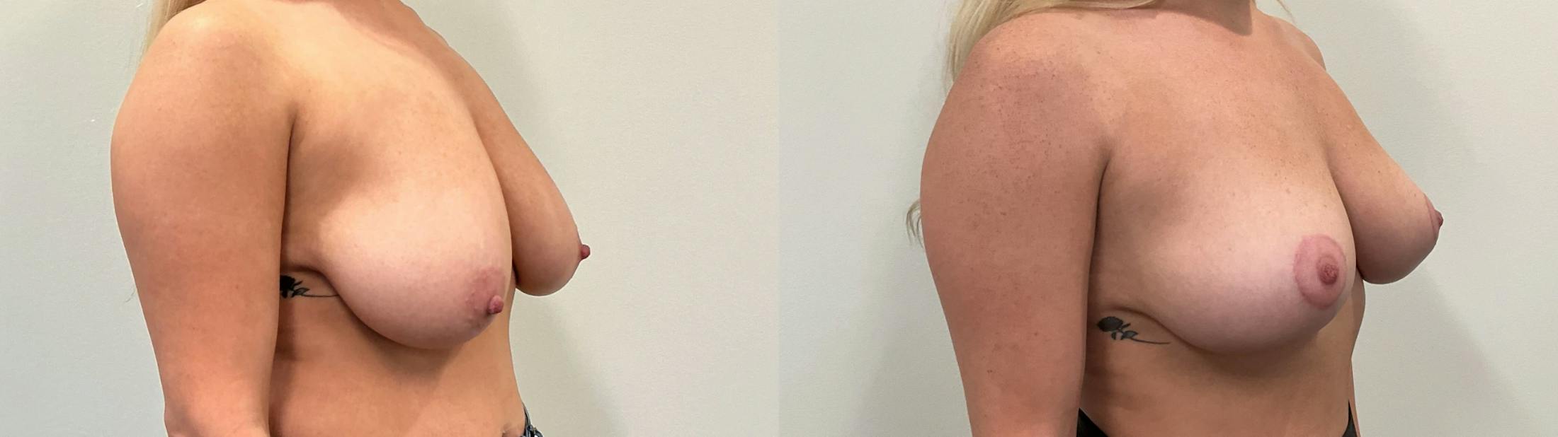 Breast Augmentation Before & After Gallery - Patient 869710 - Image 2