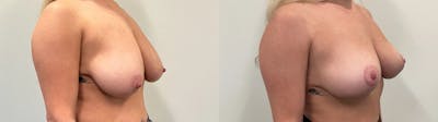 Breast Augmentation Before & After Gallery - Patient 869710 - Image 2