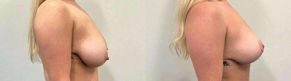 Breast Augmentation Before & After Gallery - Patient 869710 - Image 3
