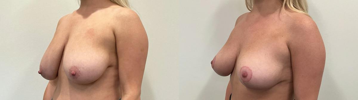 Breast Augmentation Before & After Gallery - Patient 869710 - Image 4