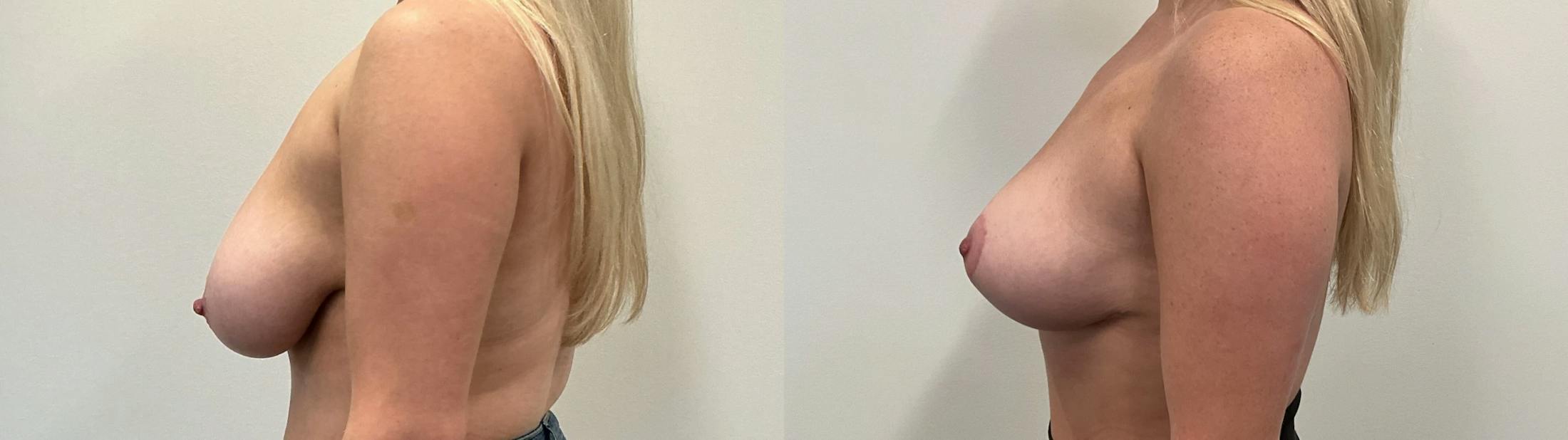 Breast Augmentation Before & After Gallery - Patient 869710 - Image 5