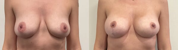 Breast Lift Before & After Gallery - Patient 196941 - Image 1