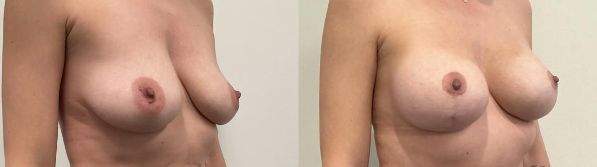 Breast Augmentation Before & After Gallery - Patient 344525 - Image 2